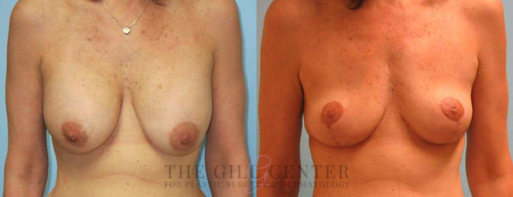 Breast Revisions Case 379 Before & After Front | The Woodlands, TX | The Gill Center for Plastic Surgery and Dermatology