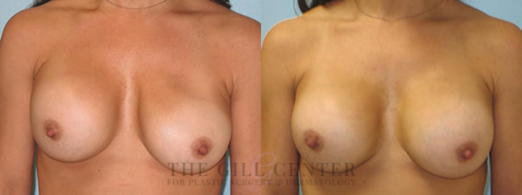 Breast Revisions Case 380 Before & After Front | The Woodlands, TX | The Gill Center for Plastic Surgery and Dermatology