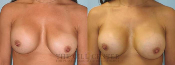 Breast Revisions Case 380 Before & After Front | The Woodlands, TX | The Gill Center for Plastic Surgery and Dermatology