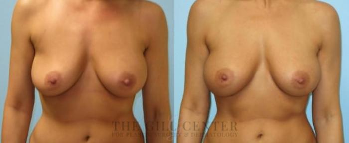 Breast Revisions Case 381 Before & After Front | The Woodlands, TX | The Gill Center for Plastic Surgery and Dermatology