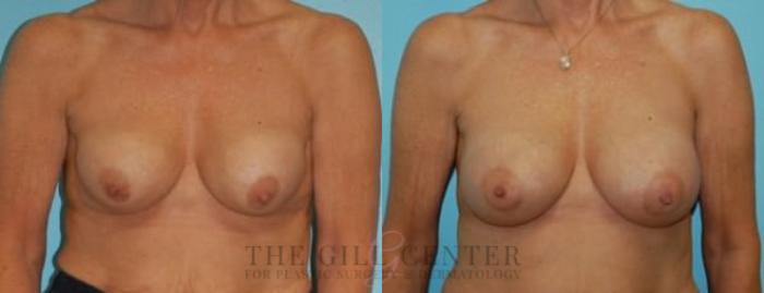 Breast Revisions Case 383 Before & After Front | The Woodlands, TX | The Gill Center for Plastic Surgery and Dermatology