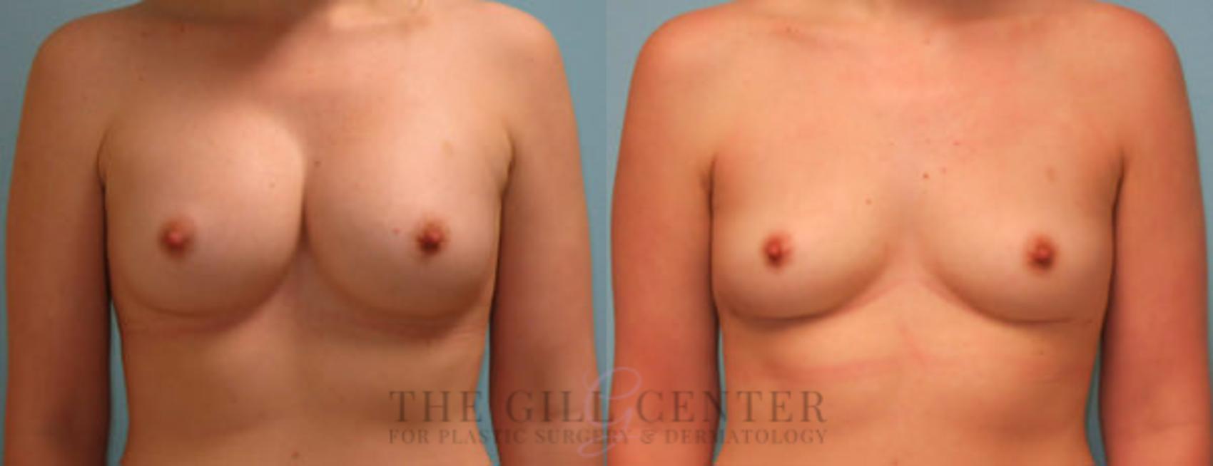 Breast Revisions Case 388 Before & After Front | The Woodlands, TX | The Gill Center for Plastic Surgery and Dermatology