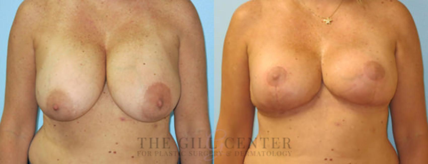 Breast Revisions Case 389 Before & After Front | The Woodlands, TX | The Gill Center for Plastic Surgery and Dermatology
