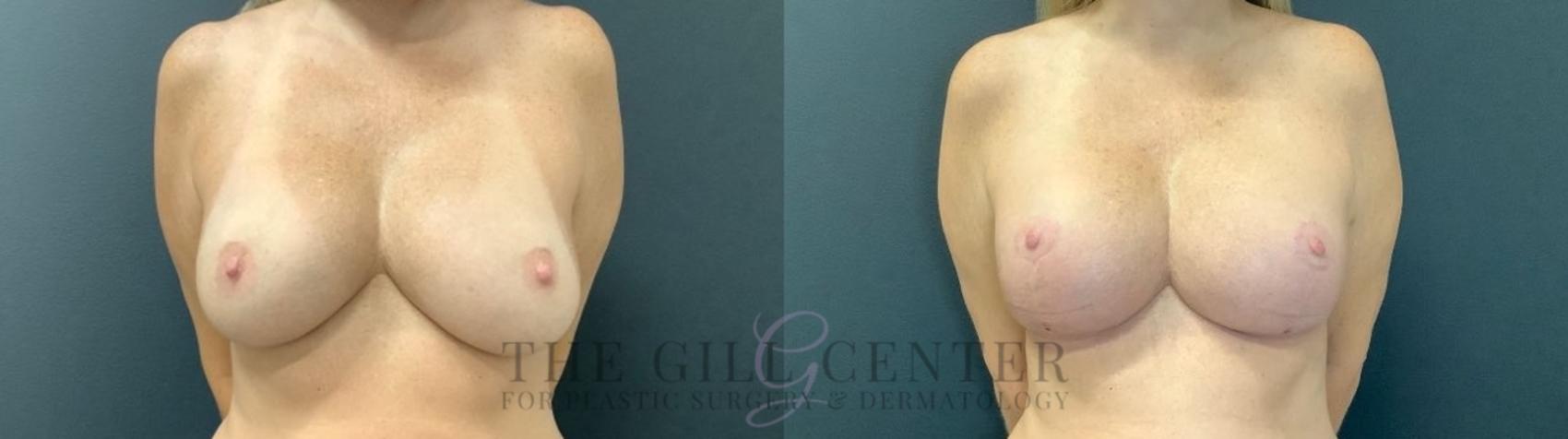 Breast Revisions Case 473 Before & After Front | The Woodlands, TX | The Gill Center for Plastic Surgery and Dermatology