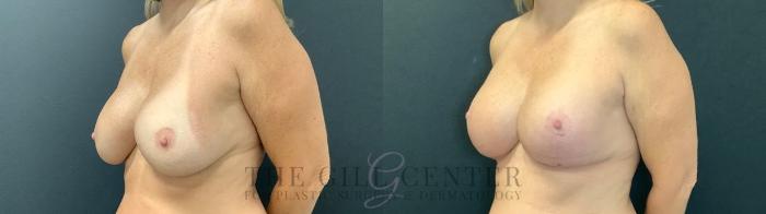 Breast Revisions Case 473 Before & After Left Oblique | The Woodlands, TX | The Gill Center for Plastic Surgery and Dermatology