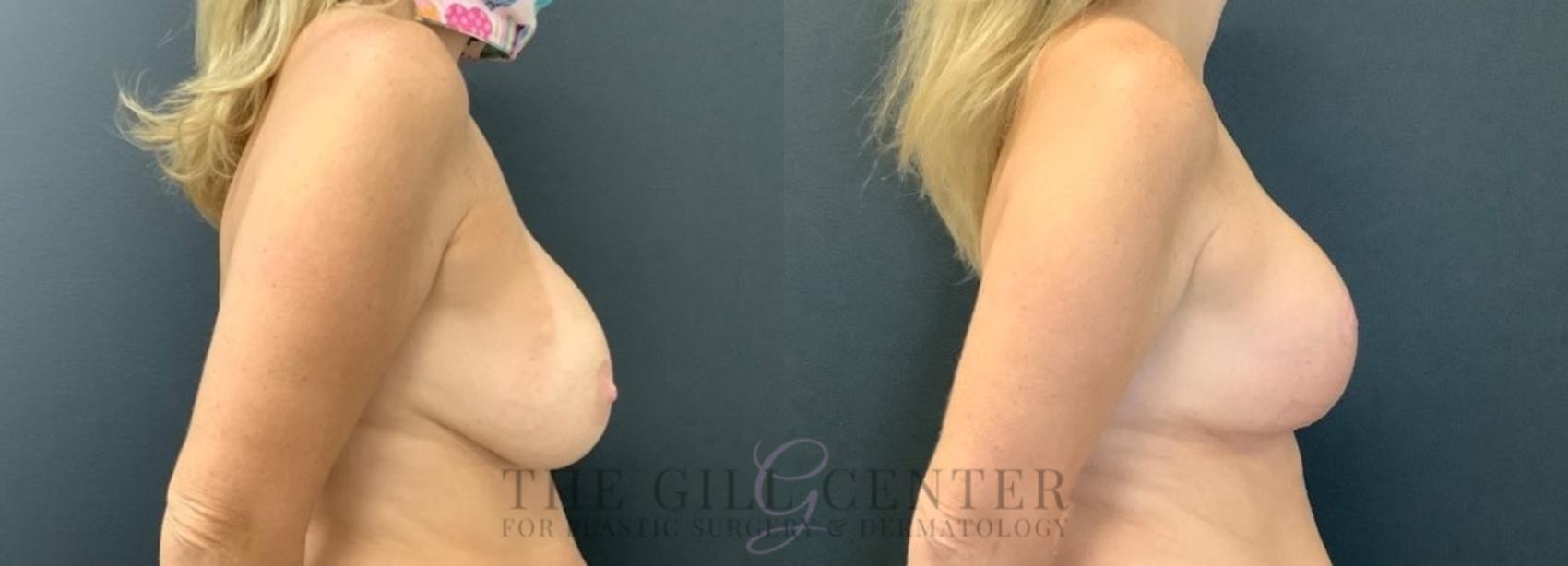 Breast Revisions Case 473 Before & After Right Side | The Woodlands, TX | The Gill Center for Plastic Surgery and Dermatology