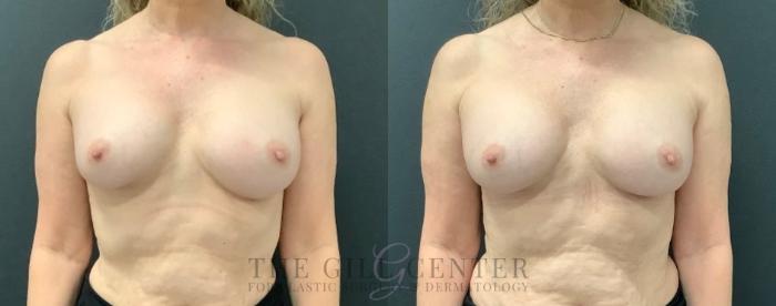 Breast Revisions Case 558 Before & After Front | The Woodlands, TX | The Gill Center for Plastic Surgery and Dermatology