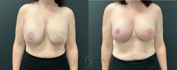 Breast Revisions Case 560 Before & After Front | The Woodlands, TX | The Gill Center for Plastic Surgery and Dermatology