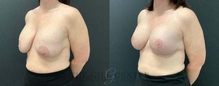 Breast Revisions Case 560 Before & After Left Oblique | The Woodlands, TX | The Gill Center for Plastic Surgery and Dermatology