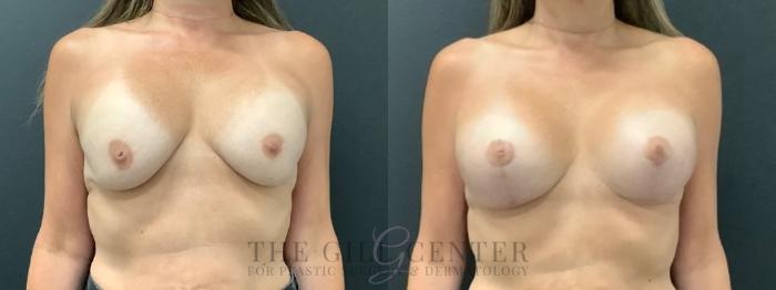 Breast Lift with Implants Case 585 Before & After Front | The Woodlands, TX | The Gill Center for Plastic Surgery and Dermatology