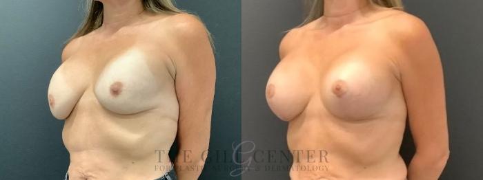 Breast Revisions Case 585 Before & After Left Oblique | The Woodlands, TX | The Gill Center for Plastic Surgery and Dermatology