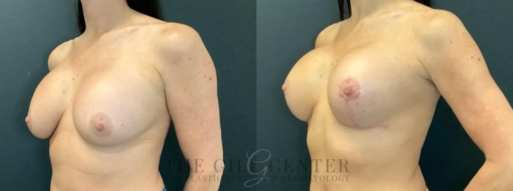 Breast Revisions Case 628 Before & After Left Oblique | The Woodlands, TX | The Gill Center for Plastic Surgery and Dermatology