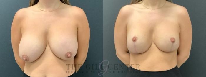 Breast Revisions Case 638 Before & After Front | The Woodlands, TX | The Gill Center for Plastic Surgery and Dermatology