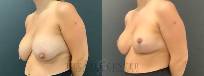 Breast Revisions Case 638 Before & After Left Oblique | The Woodlands, TX | The Gill Center for Plastic Surgery and Dermatology