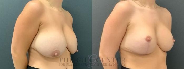 Breast Revisions Case 638 Before & After Right Oblique | The Woodlands, TX | The Gill Center for Plastic Surgery and Dermatology