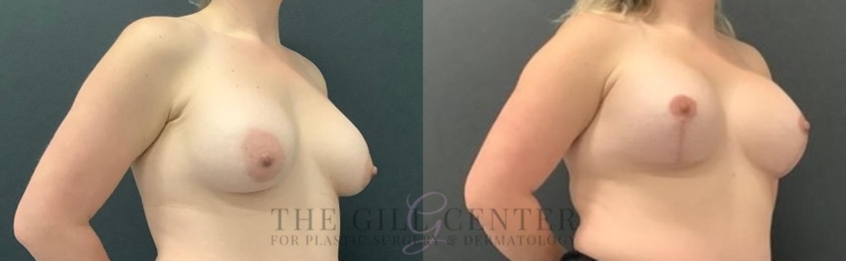 Breast Revisions Case 639 Before & After Right Oblique | The Woodlands, TX | The Gill Center for Plastic Surgery and Dermatology