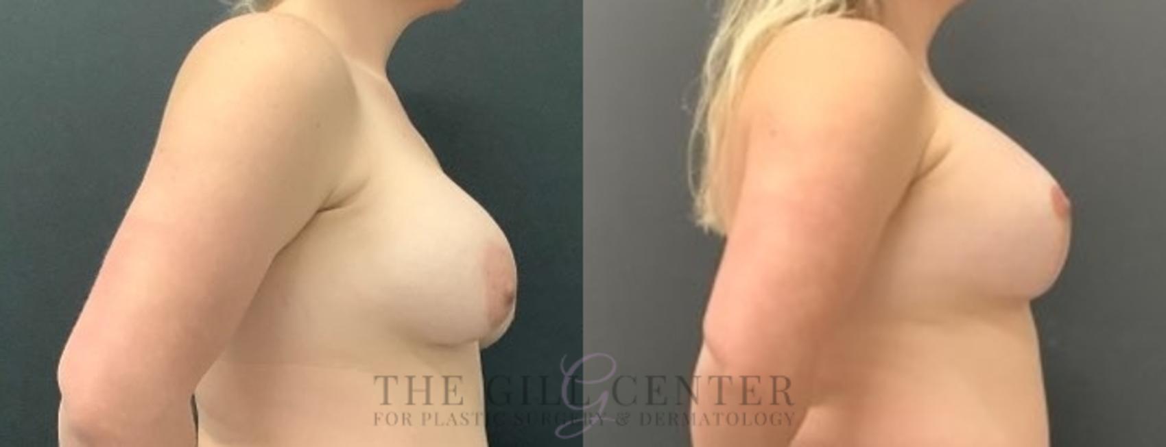 Breast Revisions Case 639 Before & After Right Side | The Woodlands, TX | The Gill Center for Plastic Surgery and Dermatology