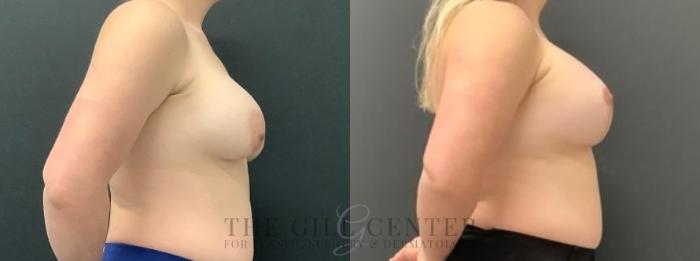 Breast Revisions Case 639 Before & After Right Side | The Woodlands, TX | The Gill Center for Plastic Surgery and Dermatology