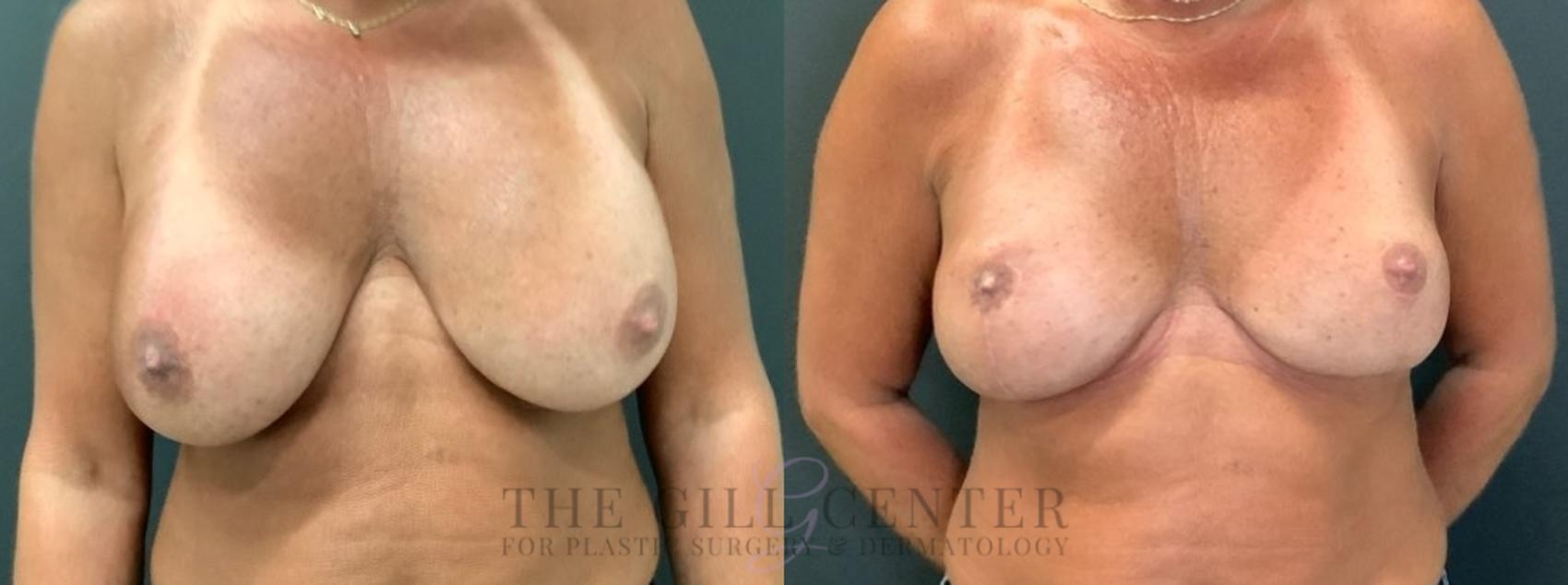 Breast Revisions Case 648 Before & After Front | The Woodlands, TX | The Gill Center for Plastic Surgery and Dermatology