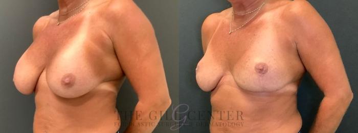 Breast Revisions Case 648 Before & After Left Oblique | The Woodlands, TX | The Gill Center for Plastic Surgery and Dermatology