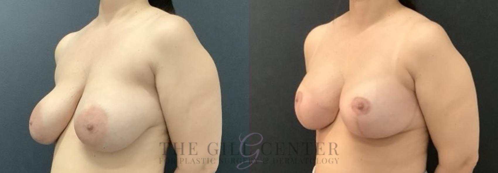 Breast Revisions Case 684 Before & After Left Side | The Woodlands, TX | The Gill Center for Plastic Surgery and Dermatology