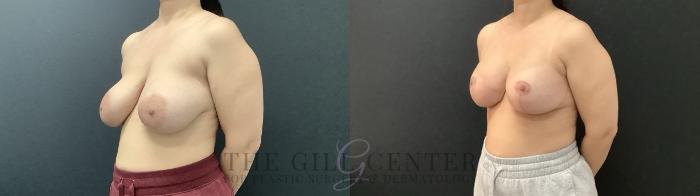 Breast Revisions Case 684 Before & After Left Side | The Woodlands, TX | The Gill Center for Plastic Surgery and Dermatology