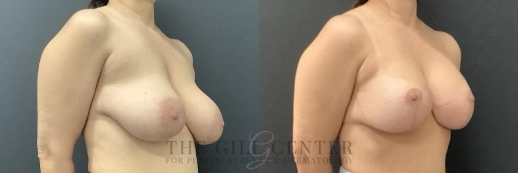 Breast Revisions Case 684 Before & After Right Side | The Woodlands, TX | The Gill Center for Plastic Surgery and Dermatology