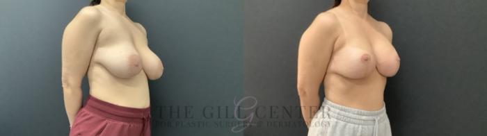 Breast Revisions Case 684 Before & After Right Side | The Woodlands, TX | The Gill Center for Plastic Surgery and Dermatology