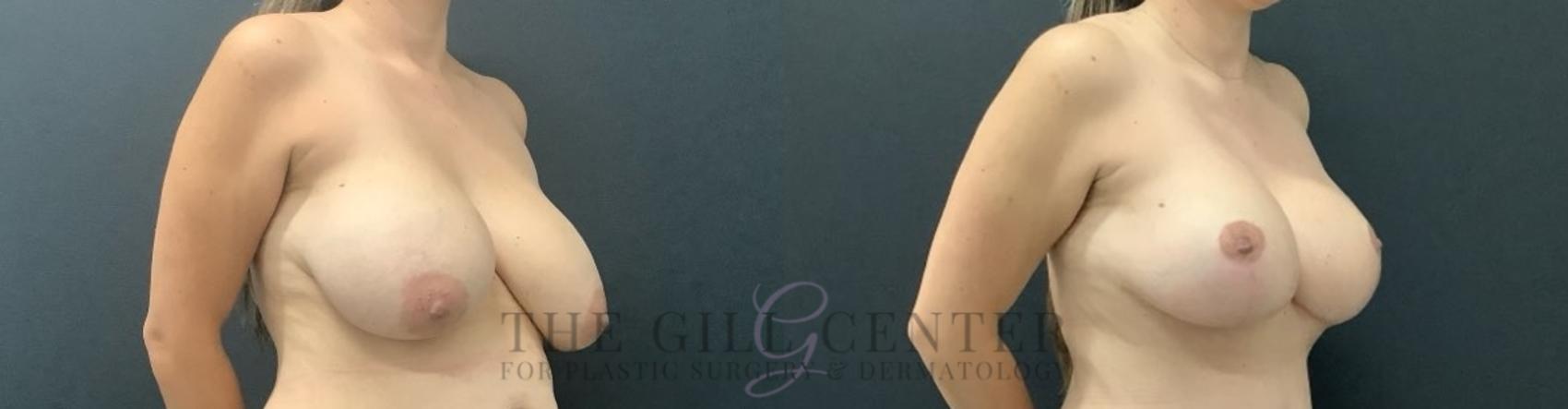 Breast Revisions Case 691 Before & After Right Side | The Woodlands, TX | The Gill Center for Plastic Surgery and Dermatology