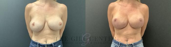 Breast Revisions Case 692 Before & After Front | The Woodlands, TX | The Gill Center for Plastic Surgery and Dermatology