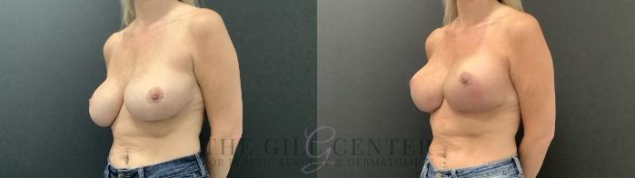 Breast Revisions Case 692 Before & After Left Side | The Woodlands, TX | The Gill Center for Plastic Surgery and Dermatology