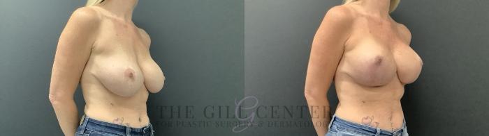 Breast Revisions Case 692 Before & After Right Side | The Woodlands, TX | The Gill Center for Plastic Surgery and Dermatology