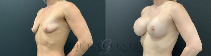 Breast Revisions Case 694 Before & After Left Side | The Woodlands, TX | The Gill Center for Plastic Surgery and Dermatology