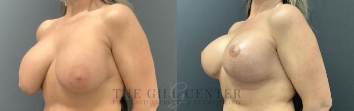 Breast Revisions Case 709 Before & After Left Side | The Woodlands, TX | The Gill Center for Plastic Surgery and Dermatology