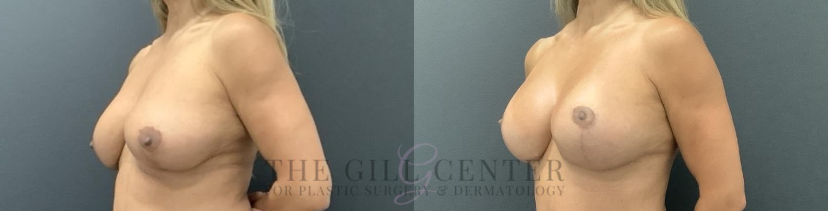 Breast Revisions Case 728 Before & After Left Oblique | The Woodlands, TX | The Gill Center for Plastic Surgery and Dermatology