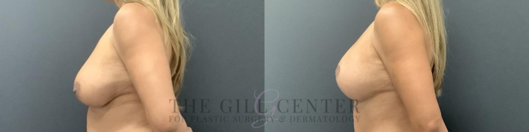 Breast Revisions Case 728 Before & After Left Side | The Woodlands, TX | The Gill Center for Plastic Surgery and Dermatology