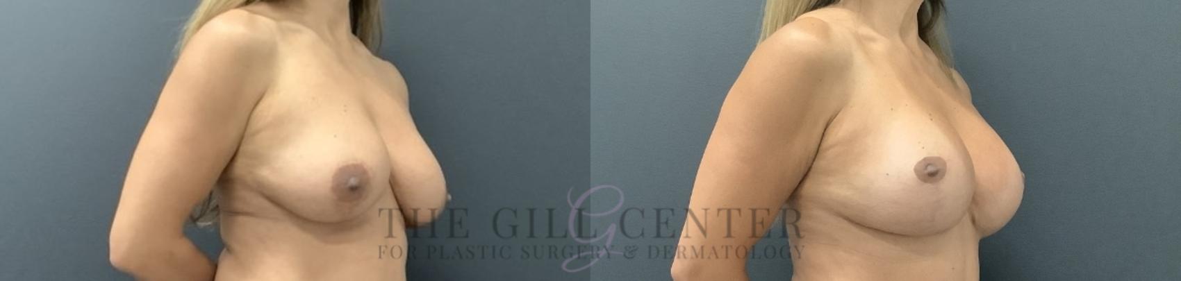 Breast Revisions Case 728 Before & After Right Oblique | The Woodlands, TX | The Gill Center for Plastic Surgery and Dermatology