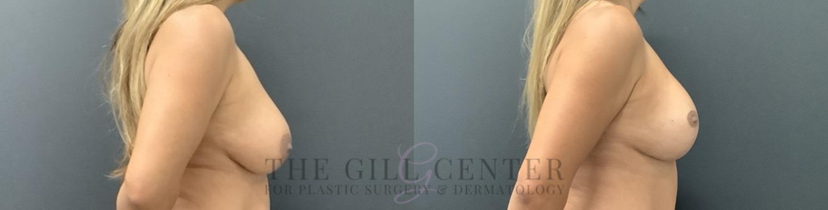 Breast Revisions Case 728 Before & After Right Side | The Woodlands, TX | The Gill Center for Plastic Surgery and Dermatology