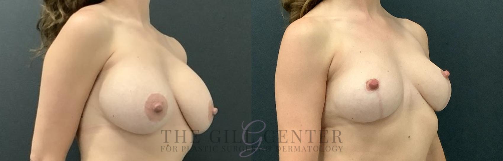 Breast Revisions Case 731 Before & After Right Oblique | The Woodlands, TX | The Gill Center for Plastic Surgery and Dermatology