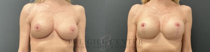 Breast Revisions Case 807 Before & After Front | The Woodlands, TX | The Gill Center for Plastic Surgery and Dermatology