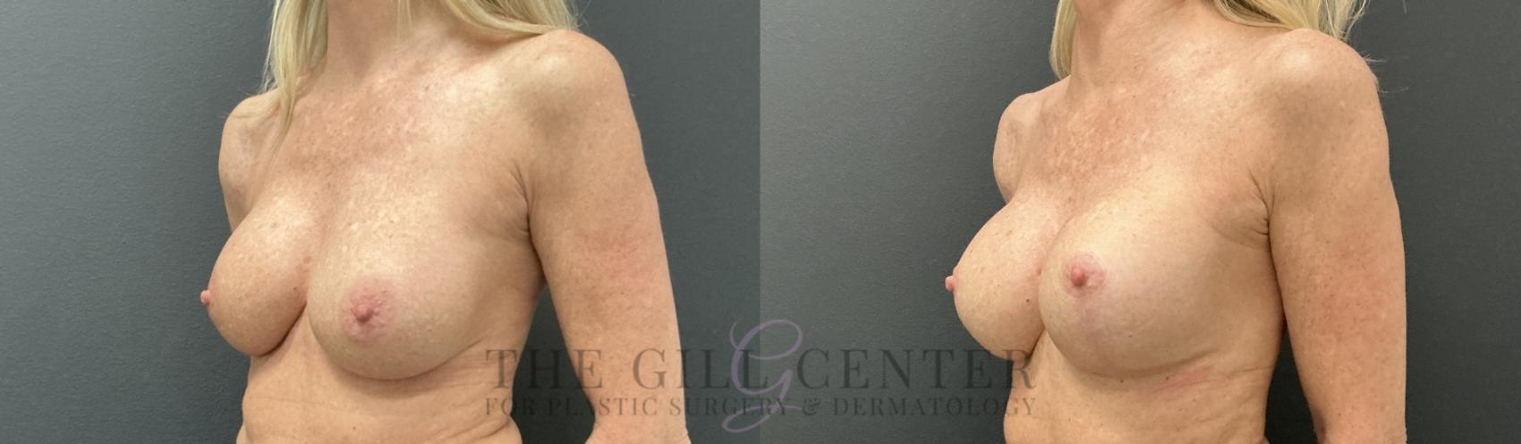 Breast Revisions Case 807 Before & After Left Oblique | The Woodlands, TX | The Gill Center for Plastic Surgery and Dermatology