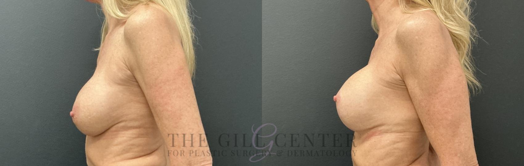 Breast Revisions Case 807 Before & After Left Side | The Woodlands, TX | The Gill Center for Plastic Surgery and Dermatology