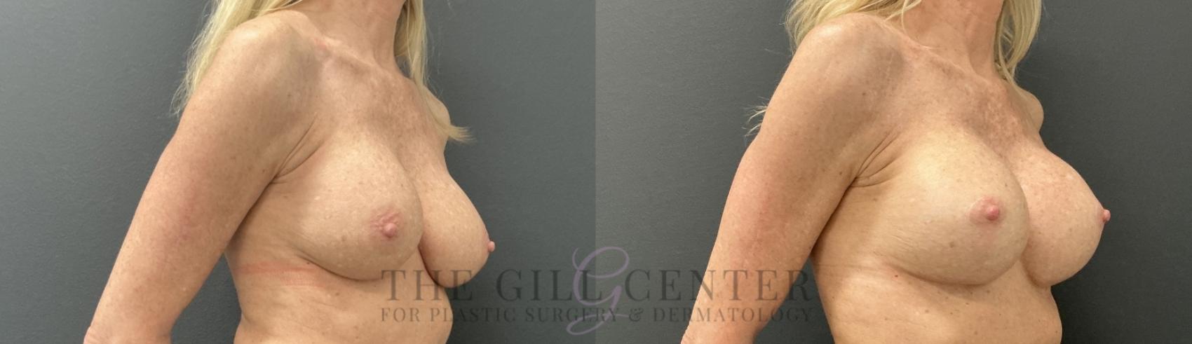 Breast Revisions Case 807 Before & After Right Oblique | The Woodlands, TX | The Gill Center for Plastic Surgery and Dermatology