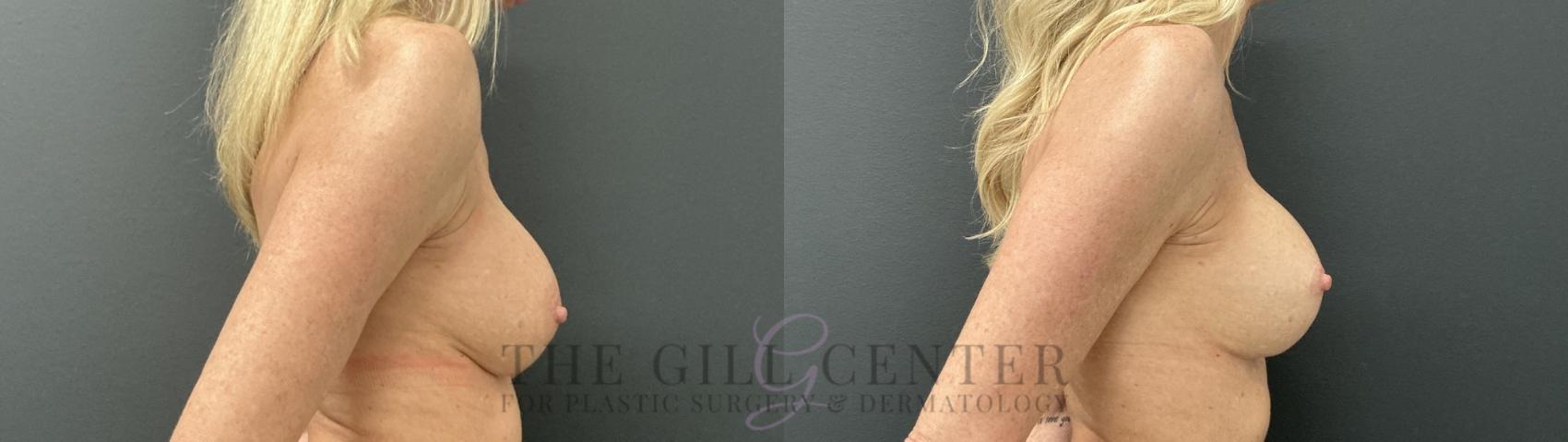 Breast Revisions Case 807 Before & After Right Side | The Woodlands, TX | The Gill Center for Plastic Surgery and Dermatology