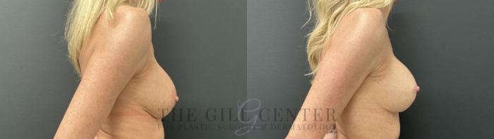 Breast Revisions Case 807 Before & After Right Side | The Woodlands, TX | The Gill Center for Plastic Surgery and Dermatology