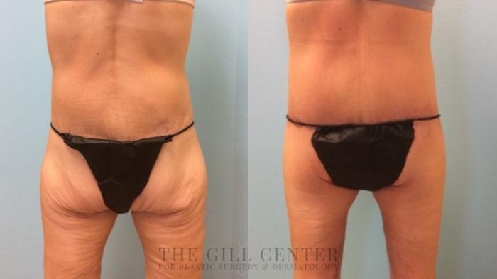 Butt Lift Case 484 Before & After Back | The Woodlands, TX | The Gill Center for Plastic Surgery and Dermatology