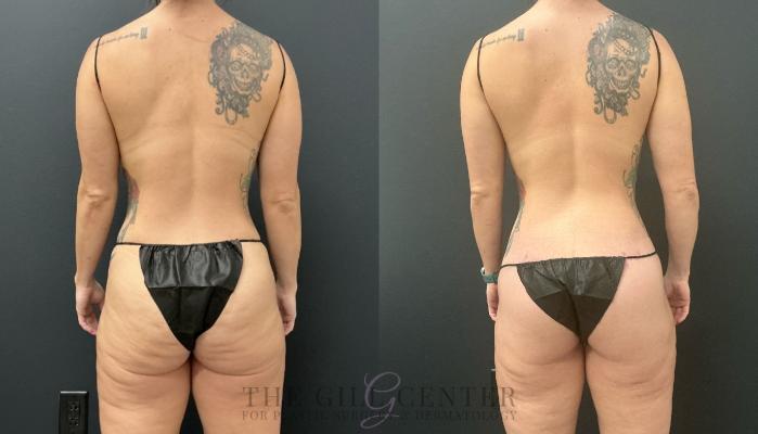 Butt Lift Case 734 Before & After Back | The Woodlands, TX | The Gill Center for Plastic Surgery and Dermatology