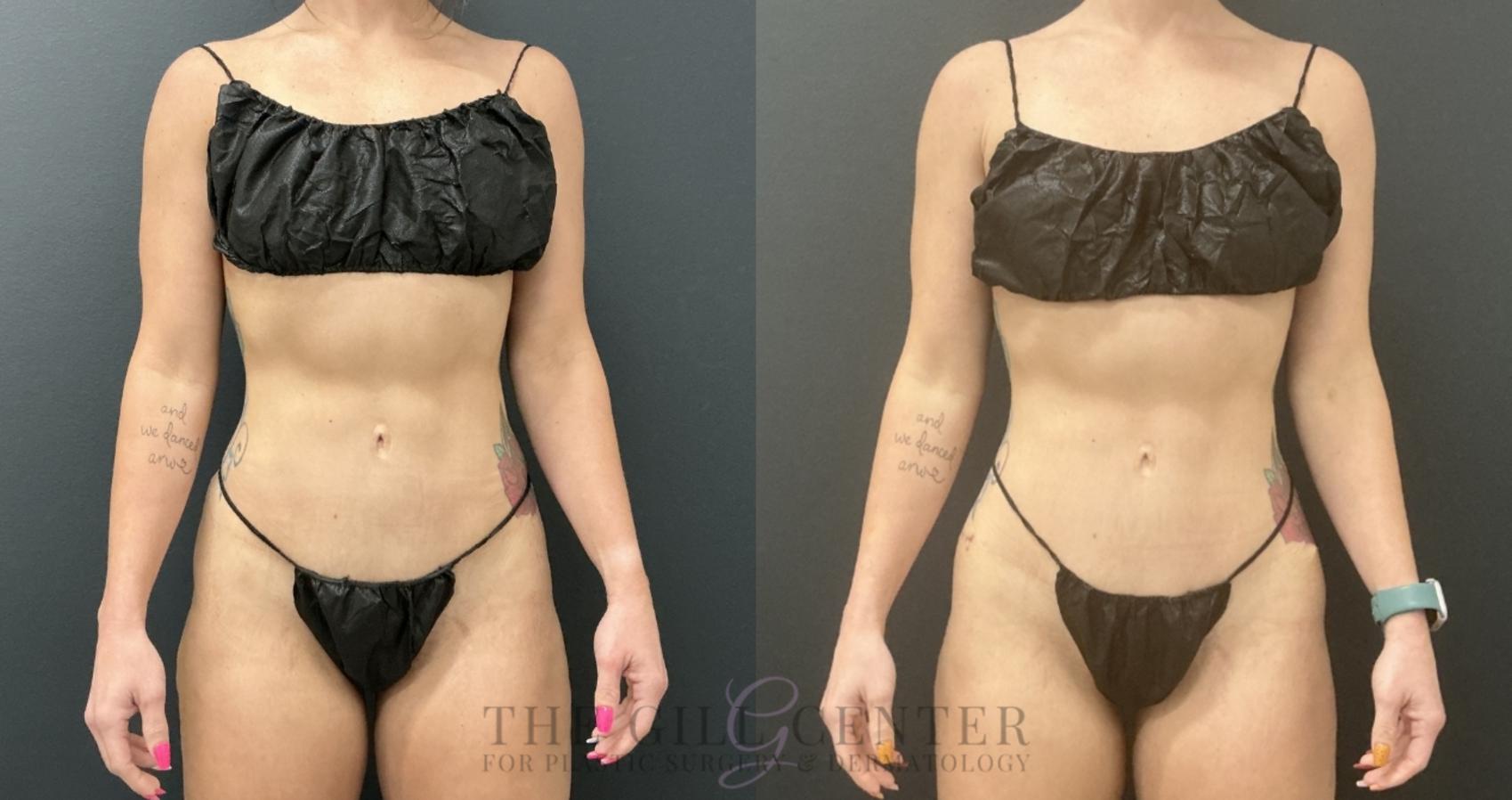 Butt Lift Case 734 Before & After Front | The Woodlands, TX | The Gill Center for Plastic Surgery and Dermatology