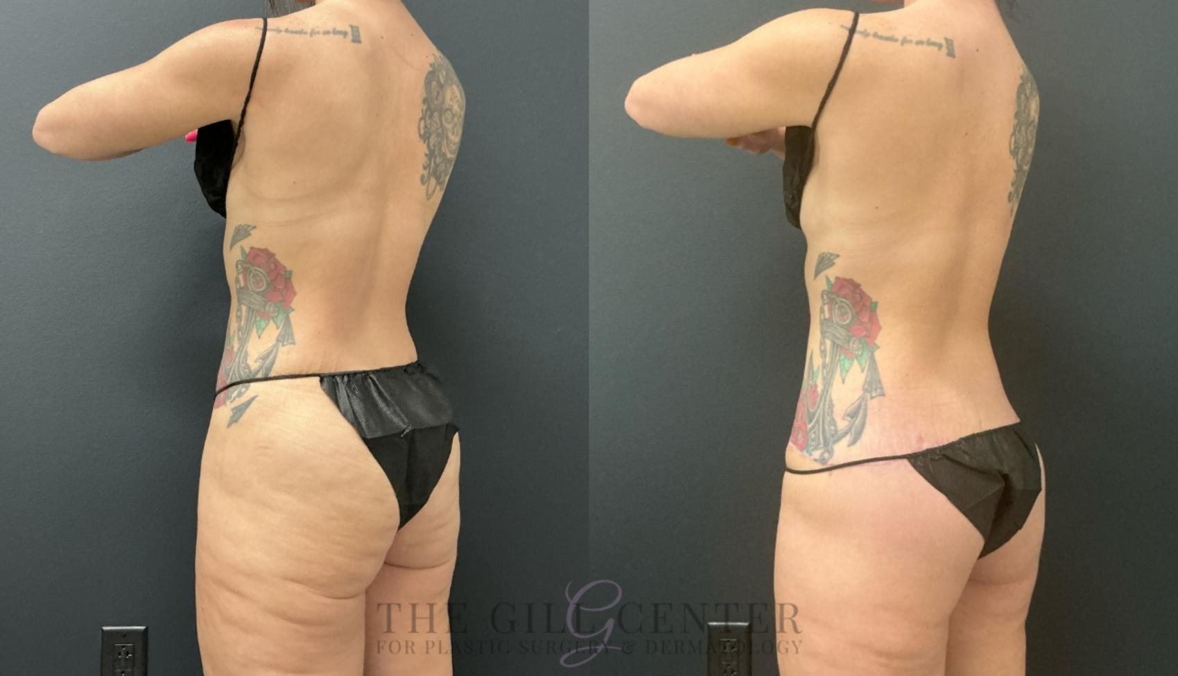 Butt Lift Case 734 Before & After Left Oblique | The Woodlands, TX | The Gill Center for Plastic Surgery and Dermatology