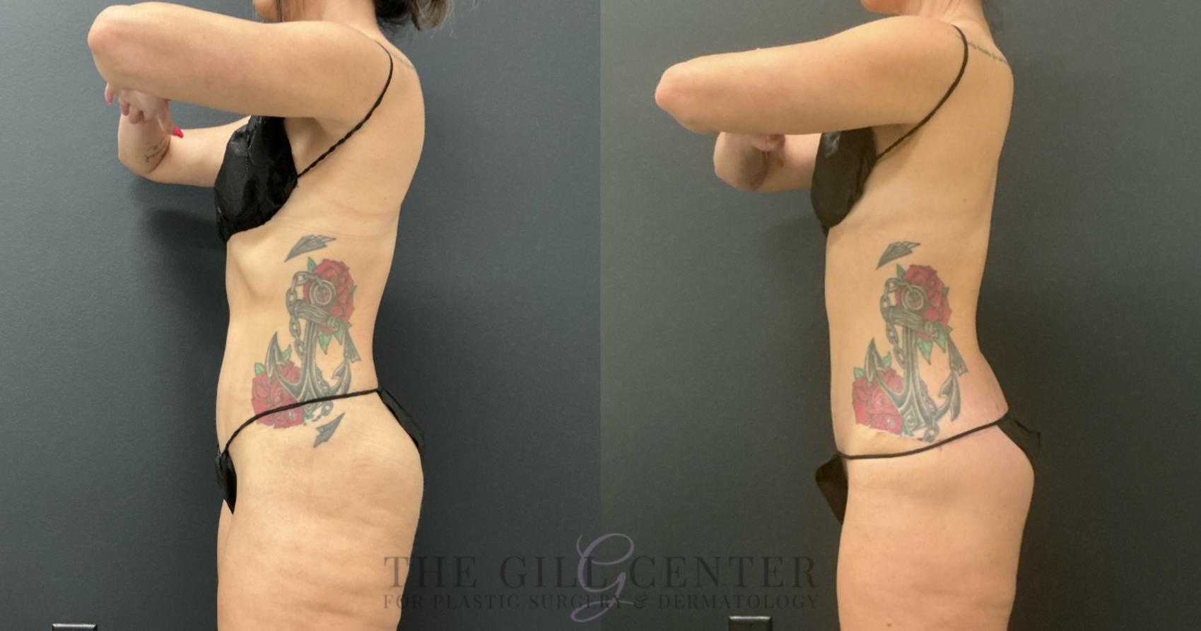 Butt Lift Case 734 Before & After Left Side | The Woodlands, TX | The Gill Center for Plastic Surgery and Dermatology